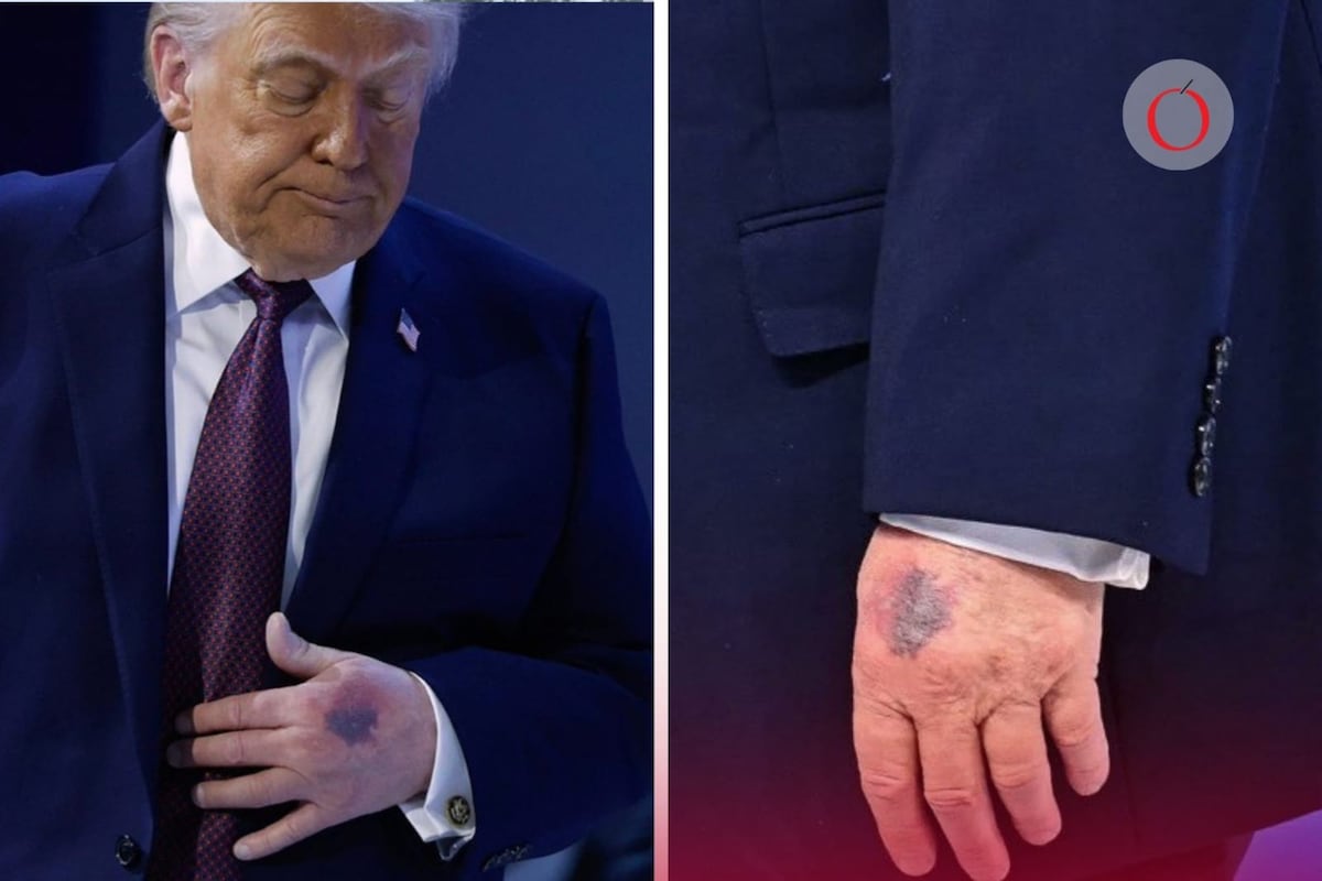 El Presidente Trump enfrenta un nuevo desafío en Washington: los detalles del incidente que le causó la lesión facial y las implicaciones políticas para su mandato.